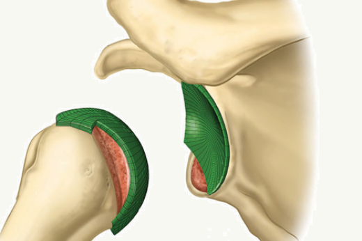 A Theoretical Model of the Effect of Bone Defects on Anterior Shoulder Instability